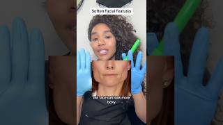 Softening facial features for more feminine look botox filler [upl. by Naot]