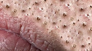 Big Cystic Acne Blackheads Extraction Blackheads amp Milia Whiteheads Removal Pimple Popping  1201 [upl. by Ahsimrac309]