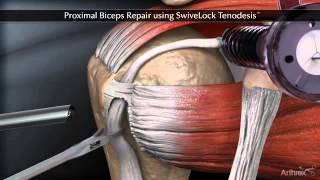 Тенодез сухожилия длинной головки бицепса Proximal Biceps Repair using SwiveLock Tenodesis [upl. by Sigmund]