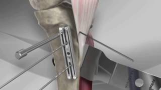 Tibial Tubercle Osteotomy with Arthrex® T3 AMZ System [upl. by Sirrap]