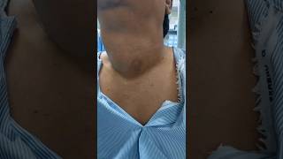 THYROID GOITER patient from TIRUPATI  kya hum unki thyroid SURGERY ko rok sake thyroidnodule [upl. by Calendra]