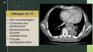 Patología de esófago II Hernia hiatal Trauma esofágico Mallory Weiss Boerhaave parte 2 [upl. by Ainekahs183]