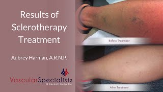 What Are the Results of Sclerotherapy Treatment [upl. by Atisusej516]