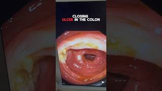 Surgical Treatment for Ulcerative Colon Conditions  Colon Cancer Awareness and Prevention [upl. by Eniretac]