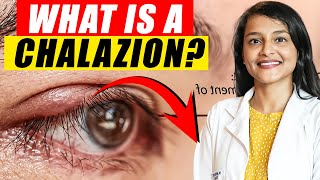 What is a Chalazion  Chalazion Disease  Chalazion Removal  Chalazion Treatment [upl. by Buote983]