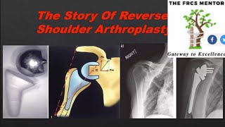 The Story Of Reverse Shoulder Replacement [upl. by Tristam]