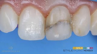 Direct composite bondingveneer for single tooth discolorations [upl. by Rehpetsirhc192]