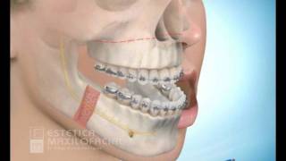 Cirugia maxilofacial  Avance del maxilar superior con retroceso mandibular [upl. by Arriaet637]