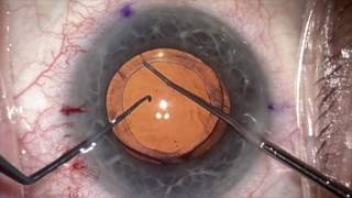 Rotated Toric repair 2 years post cataract surgery by Steven G Safran MD [upl. by Herriott836]