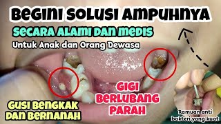 Obat Sakit Gigi Berlubang Paling Ampuh [upl. by Watts882]