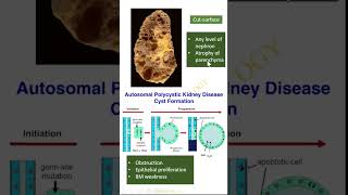 Lesions in Pathology Polycystic kidney Dr GSS SRM MCH RC httpsyoutubeBPdgqu1FE [upl. by Eicyaj575]