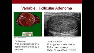 Thyroid Nodules What We Know and What We Dont Ultrasound Video [upl. by Olga416]