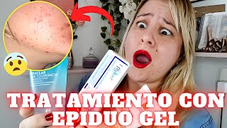 Epiduo anti acnéSerá que me funciona😱 [upl. by Nightingale910]