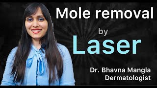 Laser Mole Removal Treatment । तिल को जड़ से हटाने का उपाय  Mole Removal Permanently [upl. by Aisorbma]