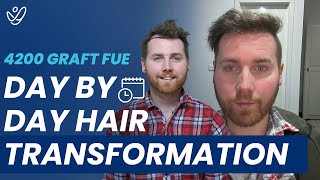 Hair Transplant Day by Day Results up to 9 Months  4200 Graft Before After with FUE [upl. by Brnaba129]