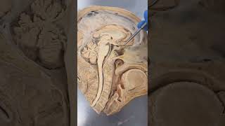 REAL Human Pituitary Gland [upl. by Pfeifer]