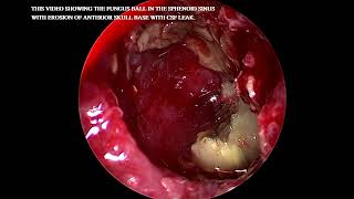 Fungal ball in Sphenoid sinus with erosion of skull base [upl. by Ainotahs320]