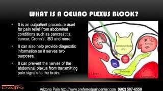 Celiac Plexus Block for Abdominal Pain Explained 602 5076550 [upl. by Ron]