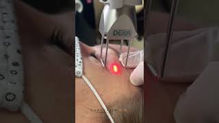 CO2 Laser for Upper Blepharoplasty Scars  with Dr Kami Parsa MD [upl. by Courtney328]