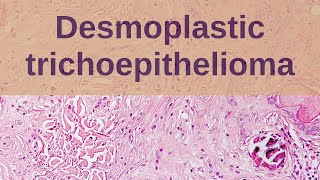 Desmoplastic Trichoepithelioma  Pathology mini tutorial [upl. by Ecnahoy]