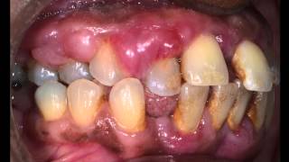 Treatment of Advanced Gum disease [upl. by Ellan]