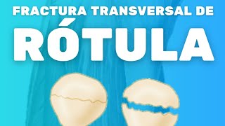 FRACTURA TRANSVERSAL DE RÓTULA [upl. by Aubine]