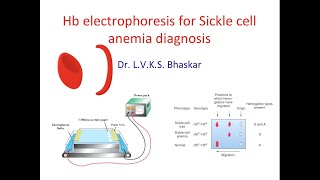 Hb electrophoresis for sickle cell anemia disease [upl. by Suhcnip]