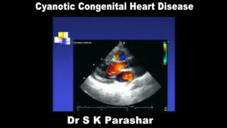 Cyanotic Congenital Heart Disease Dr S K Parashar [upl. by Lim]