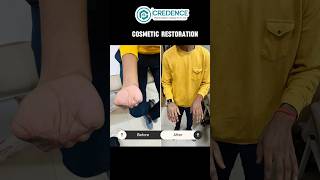 🤯😲 Nakli Hath  Silicone Cosmetic Restoration  Artificial Hand  amputation amputee shorts [upl. by Gavette521]