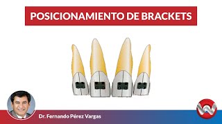 Posicionamiento de Brackets [upl. by Steele]