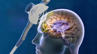 How Does Transcranial Magnetic Stimulation work [upl. by Xet]