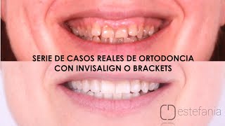 Casos REALES de ORTODONCIA con BRACKETS o INVISALIGN y BLANQUEAMIENTO DENTAL [upl. by Anoo]