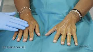 BioRePeel Treatment Protocol Hand amp Décolleté [upl. by Elohcin276]