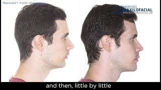 Jaw surgery Case  88 Javier  Class II facial asymmetry overbite [upl. by Aztilay188]