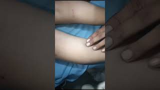 Varicose veins treatment sclerotherapydoctor pain treatment medical [upl. by Campman]