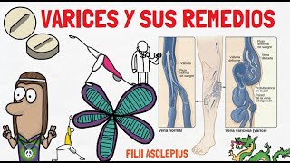 VARICES EN LAS PIERNAS  POR QUÉ OCURREN Y REMEDIOS NATURALES PARA PREVENIRLAS [upl. by Schargel141]