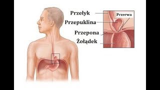 Przepuklina rozworu przełykowego – Jak ją leczyć [upl. by Nivra]