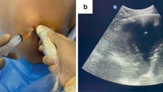 pleural fluid aspiration [upl. by Elfie]