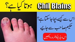 Chilblains Treatment  Swollen hands and fingers in winter  By Hakeem ObaidurRehman [upl. by Novert949]