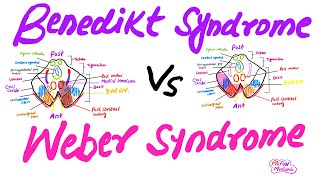 Benedikt syndrome Vs Weber syndrome Mnemonic for USMLEPlab [upl. by Novi687]