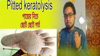 Pitted keratolysis  Pitted keratolysis treatment  পায়ের নিচে ছোট ছোট গর্ত হয়ে যাওয়া। [upl. by Odnalref]