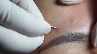 Acne Blackheads Whiteheads removals on face part 1 [upl. by Maximilianus]