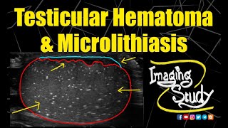 Testicular Hematoma amp Microlithiasis  Ultrasound  Case 205 [upl. by Noramac]