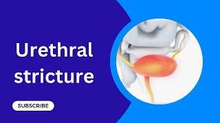 Urethral stricture Diseases of Urethra [upl. by Leanna]