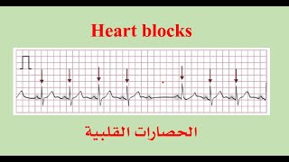 Heart blocks [upl. by Nallij]