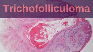 Trichofolliculoma  Pathology mini tutorial [upl. by Fedirko210]