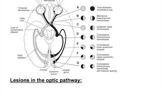 Optic nerve lesions Bitemporal hemianopia heteronymous hemianopiaHomonymous hemianopia [upl. by Notxap412]