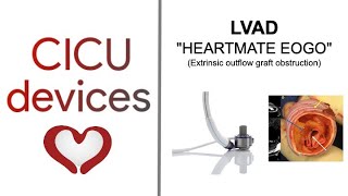 LVAD Heartmate EOGO Extrinsic Outflow Graft Obstruction lvad [upl. by Sasnak]