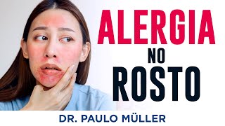 Alergia no Rosto Dermatite da Face – Dr Paulo Müller Dermatologista [upl. by Nala]