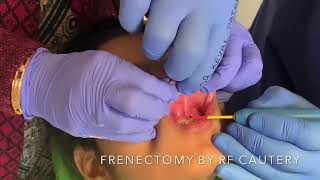 Frenectomy by RF Cautery by Dr Keval Patel at J K DENTAL HOSPITAL Ahmedabad [upl. by Keifer]